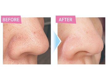 ワックス脱毛サロン アルスタ(ALUSTA)/