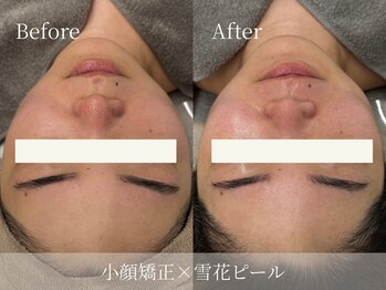 ルミセル(LUMICEL)/肌質改善の経過