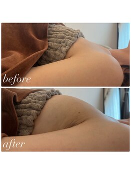 リノ 行橋(lino)/◇バストアップ症例◇ 40代