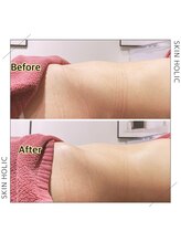 スキンホリック 恵比寿駅前店(SKIN HOLIC)/お腹☆集中ビフォア＆アフター★