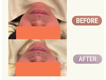 リフェムラボ(リフェムLABO)/小顔ハイドラ毛穴洗浄アンケート