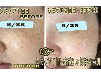 アルページュ(Arpege)/スポット的な美容国シミケア♪