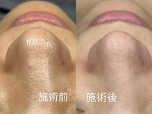 ルミエール 新宿(Lumierre)/毛穴洗浄