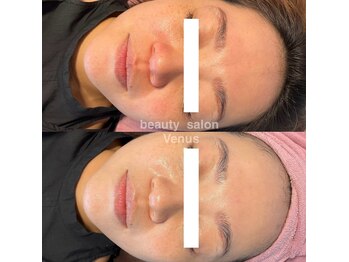 ヴィーナス(Venus)/韓国肌管理ララ/セラピール