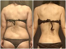 美プレミアム 川越店/背中もスッキリ！