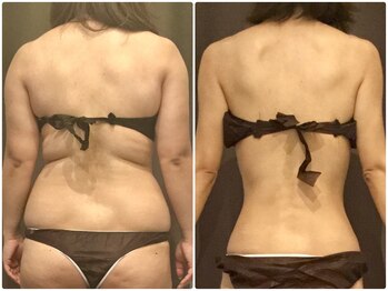 美プレミアム 川越店/背中もスッキリ!