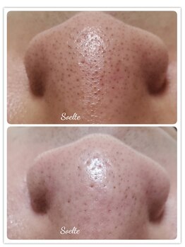 ソエルテ(Soelte)/毛穴洗浄ハイドロスプラッシュ