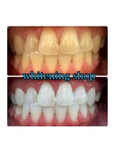 ホワイトニングショップ 所沢店/before&after美白ホワイトニング