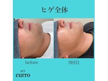 アクト クロ(ACT curro)/【ヒゲ全体】脱毛施術例