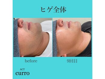 アクト クロ(ACT curro)/【ヒゲ全体】脱毛施術例