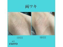 アクト クロ(ACT curro)/【両ワキ】脱毛施術例