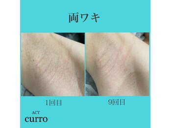 アクト クロ(ACT curro)/【両ワキ】脱毛施術例