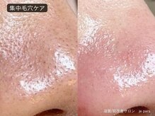 ジュパール(je pars)/毛穴エクストラクション