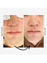 ルセヴィア(LUCEVIA)/メンズ脱毛/ひげ脱毛