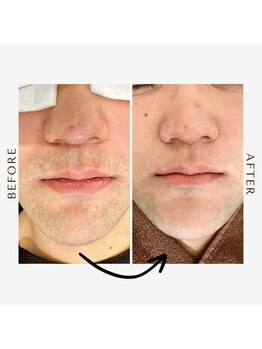 ルセヴィア(LUCEVIA)/メンズ脱毛/ひげ脱毛