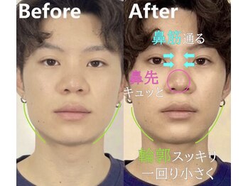ラプリ 大宮店(Raplit)/隆鼻＋輪郭矯正40分30回
