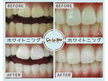 サラモ(Sa La Mo)/ホワイトニング