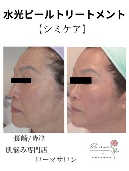 ローマサロン/シミケア☆若見え素肌美人に♪