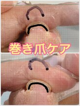 ブルーバードネイル(BLUE BIRD NAIL) 巻き爪 ケア