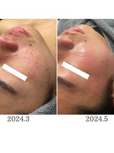 ピエノローサ(Pieno Rosa)/REVI★ハーブピーリング