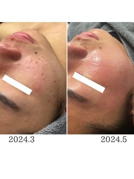 ピエノローサ(Pieno Rosa)/REVI★ハーブピーリング