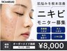 本気の肌改善!ニキビモニター大募集 ¥22,000→¥8,000