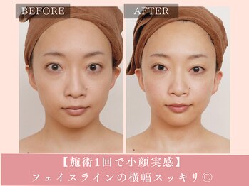 サロン ド リアン(salon de lien)/施術1回で小顔&むくみスッキリ☆