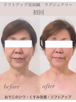 めい鍼灸院/美容鍼灸 ビフォーアフター