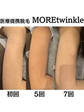 3歳のお子様や敏感肌の方も脱毛できるほどお肌に優しい！
