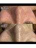 【古い角質にサヨナラ】男性も！女性も！くすみのない美肌に☆乳酸ピーリング