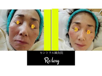 セントラル鍼灸院リラクシー(Re:laxy)/パルス美容鍼施術後驚き