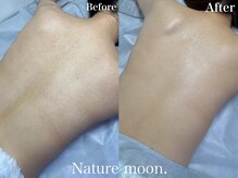 ナチュールムーン(Nature moon.)/背中ハーブピーリング