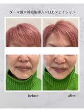 ココハリ/たるみ悩みのお客様