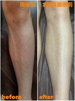 グロー(GLOW)/キッズ脱毛