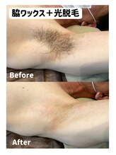 ルシェリ(Lecheri)/【脇】Wax＋光　ダブル脱毛♪