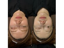 ミヨン(Miyong)/赤ら顔でお悩みの方