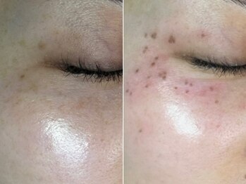 しらゆき 名古屋黒川/ターンオーバーと共にポロっと