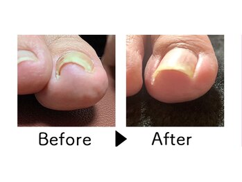 パルネイル(Pal nail)/巻き爪矯正