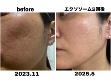 リモレア(RemoLe'a)/原液100%[エクソソーム]