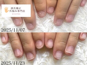 深爪矯正 爪悩み専門店 cocomo/(深爪/長さだし/フィルイン)