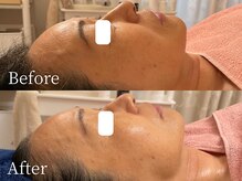 アナパ・オラ/タラソトリートメント当日の結果