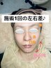 【小顔＆肌引き締めコース/筋膜・30分】