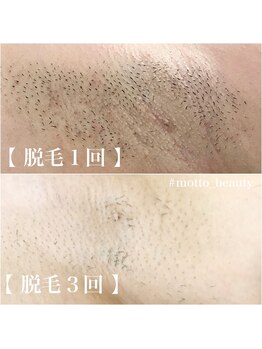 モット 神戸店(Motto)/全身脱毛