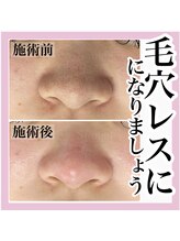 スナグル(Snuggle)/毛穴洗浄！！