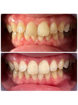 エクシアホワイトニング 日本橋店/ホワイトニング