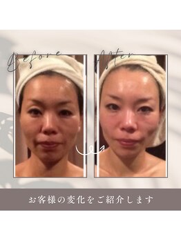 肌イズム つくば店(肌ism)/【before&after】小顔コルギ矯正