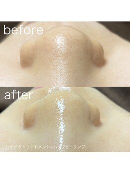 ルルラ リコ(lulula rico)/症例写真/ハイドラ毛穴洗浄