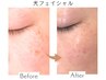 【赤み・しみ・ハリ・開き毛穴】光フェイシャル