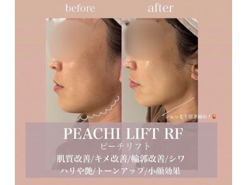 ナビ(NAVI)/韓国最新リフトアップ機械！