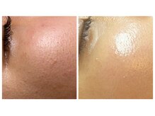 アルマ(ALMA)/肌はここまで変わる！